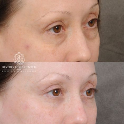female patient before and after Lower Blepharoplasty