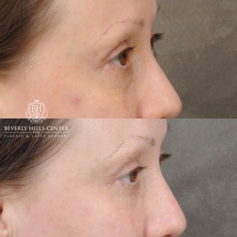 female patient before and after Lower Blepharoplasty