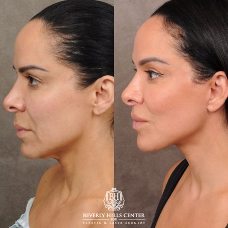 female patient before and after AuraLyft, Weekend Necklift, CUPID LIFT® Lip Lift