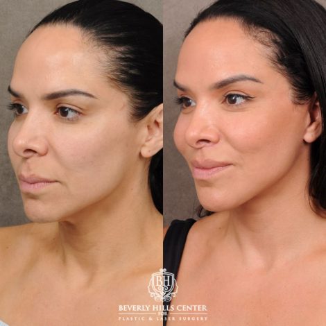 female patient before and after AuraLyft, Weekend Necklift, CUPID LIFT® Lip Lift