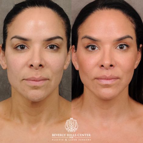 female patient before and after AuraLyft, Weekend Necklift, CUPID LIFT® Lip Lift
