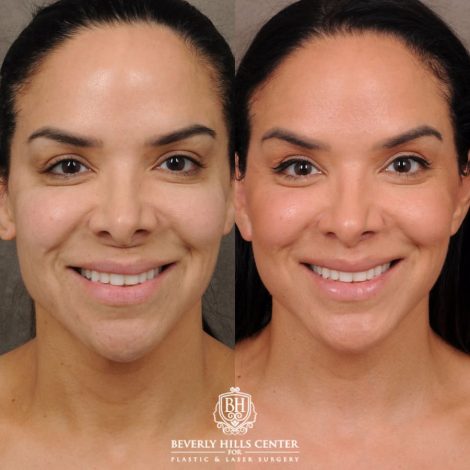 female patient before and after AuraLyft, Weekend Necklift, CUPID LIFT® Lip Lift