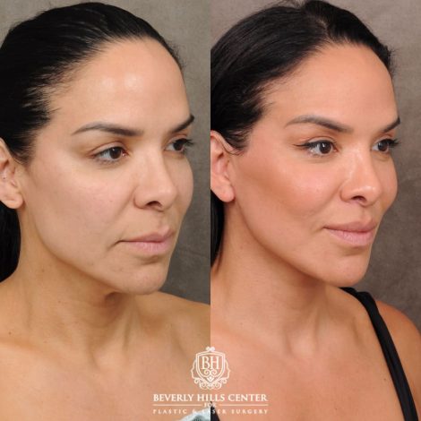 female patient before and after AuraLyft, Weekend Necklift, CUPID LIFT® Lip Lift