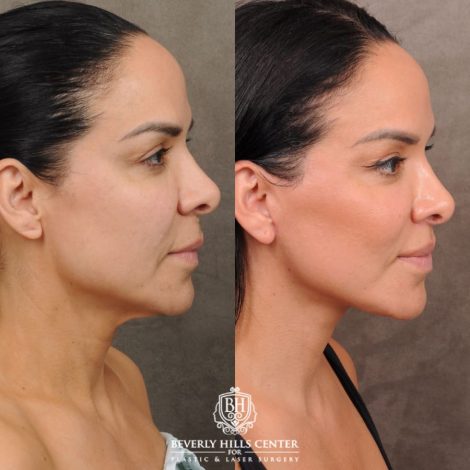 female patient before and after AuraLyft, Weekend Necklift, CUPID LIFT® Lip Lift