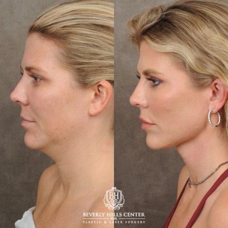 female patient before and after Weekend Necklift, Profound RF