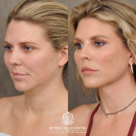 female patient before and after Weekend Necklift, Profound RF