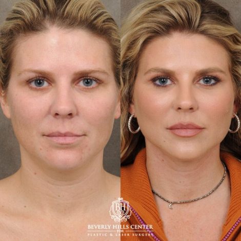female patient before and after Weekend Necklift, Profound RF