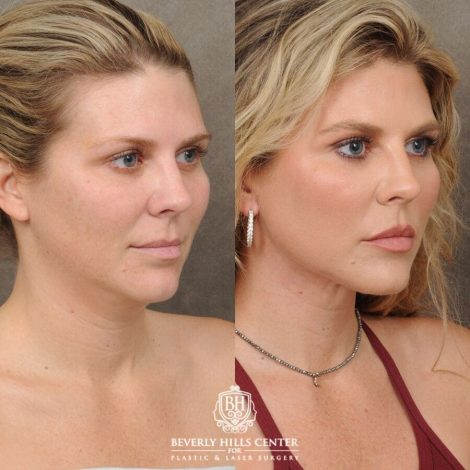 female patient before and after Weekend Necklift, Profound RF
