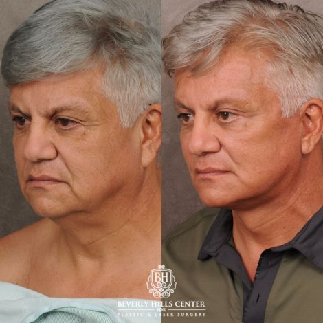 male patient before and after AuraLyft, Brow Lift, Upper Blepharoplasty, and CUPID LIFT® Corner Lift