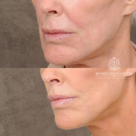 female patient before and after CUPID LIFT® Lip Lift