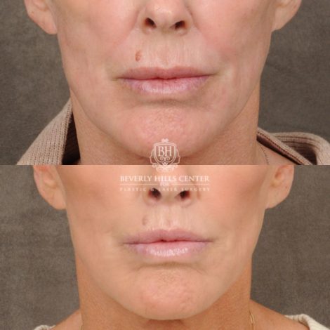 female patient before and after CUPID LIFT® Lip Lift