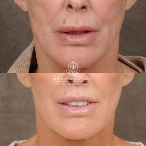 female patient before and after CUPID LIFT® Lip Lift