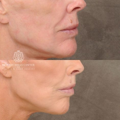 female patient before and after CUPID LIFT® Lip Lift