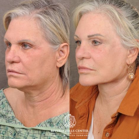 female patient before and after AuraLyft