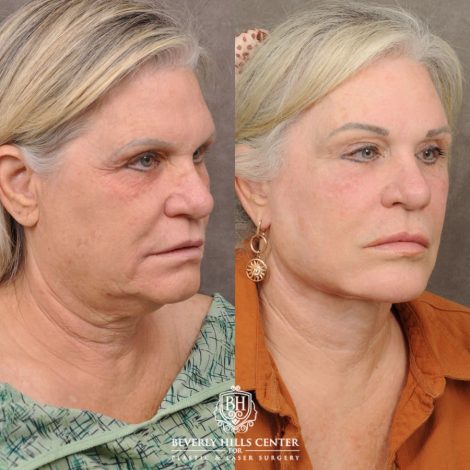 female patient before and after AuraLyft