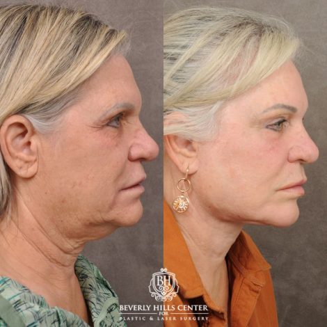 female patient before and after AuraLyft