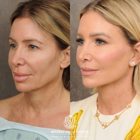 female patient before and after AuraLyft, CUPID LIFT® Lip Lift, and Upper Blepharoplasty