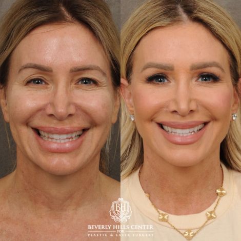 female patient before and after AuraLyft, CUPID LIFT® Lip Lift, and Upper Blepharoplasty