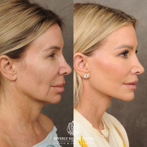female patient before and after AuraLyft, CUPID LIFT® Lip Lift, and Upper Blepharoplasty