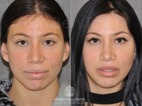 Beverly Hills Center Female Patient Before and After Modified Upper Lip Lift