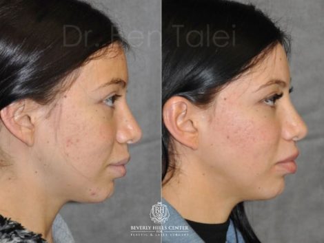 Beverly Hills Center Female Patient Before and After Modified Upper Lip Lift