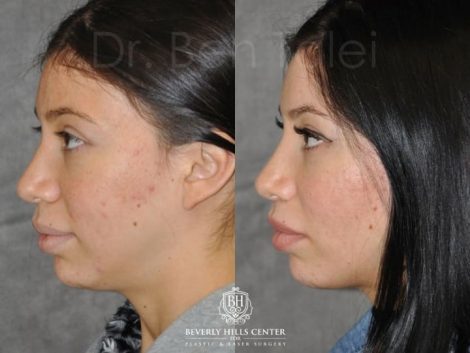 Beverly Hills Center Female Patient Before and After Modified Upper Lip Lift