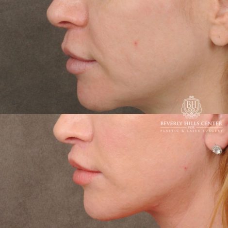 female patient before and after CUPID LIFT® Lip Lift, AuraLyft, Brow Lift