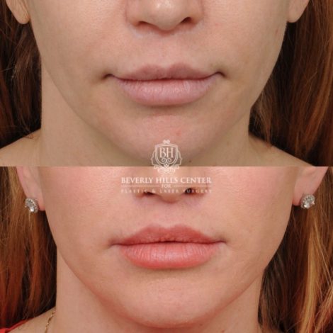female patient before and after CUPID LIFT® Lip Lift, AuraLyft, Brow Lift