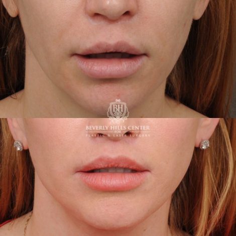 female patient before and after CUPID LIFT® Lip Lift, AuraLyft, Brow Lift