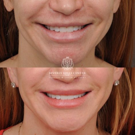 female patient before and after CUPID LIFT® Lip Lift, AuraLyft, Brow Lift