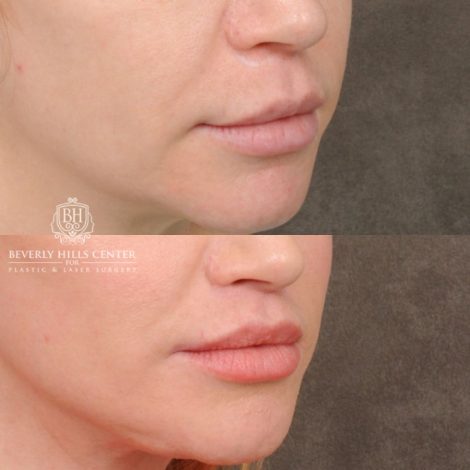 female patient before and after CUPID LIFT® Lip Lift, AuraLyft, Brow Lift
