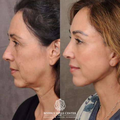 female patient before and after AuraLyft