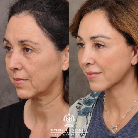 female patient before and after AuraLyft