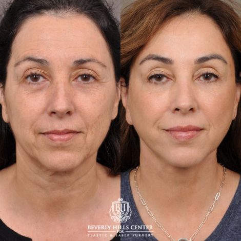 female patient before and after AuraLyft