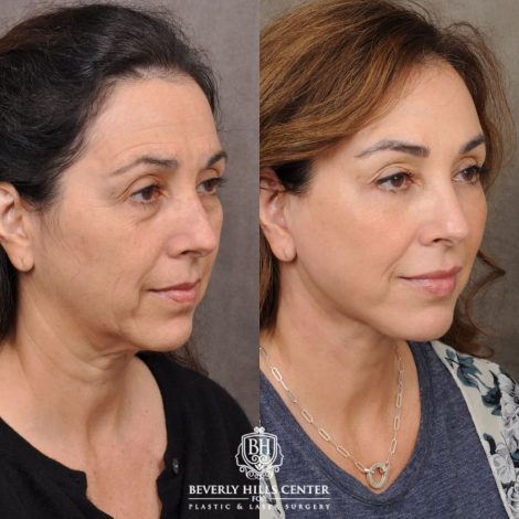 female patient before and after AuraLyft