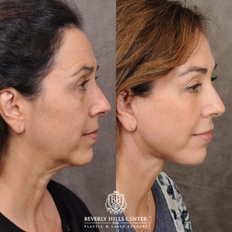 female patient before and after AuraLyft