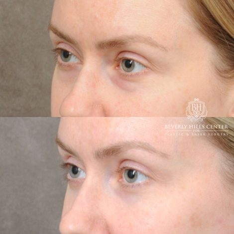 female patient before and after Weekend Necklift & Lower Blepharoplasty