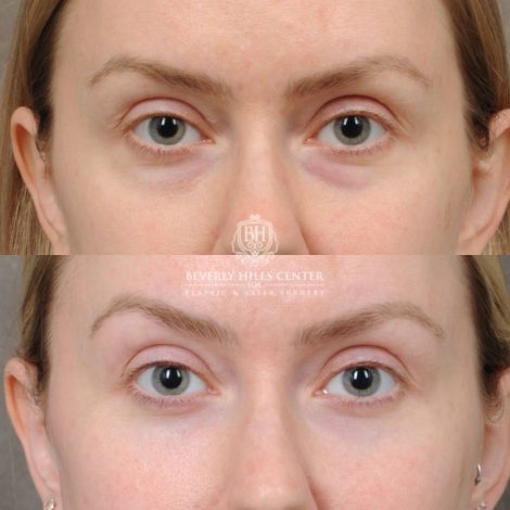 female patient before and after Weekend Necklift & Lower Blepharoplasty