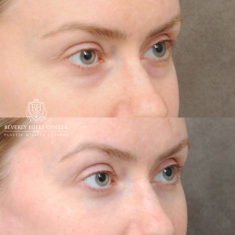 female patient before and after Weekend Necklift & Lower Blepharoplasty