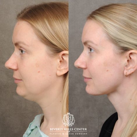 female patient before and after Weekend Necklift & Lower Blepharoplasty