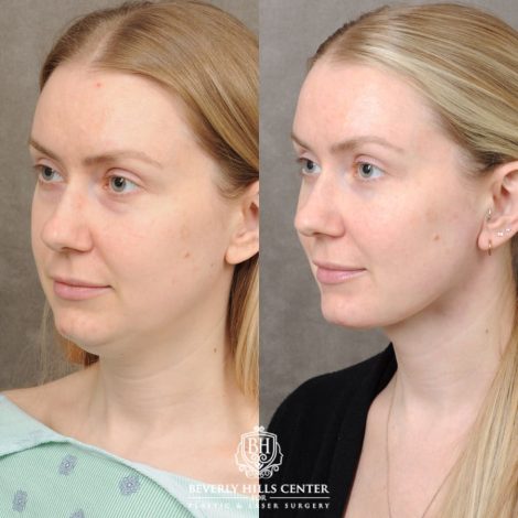 female patient before and after Weekend Necklift & Lower Blepharoplasty