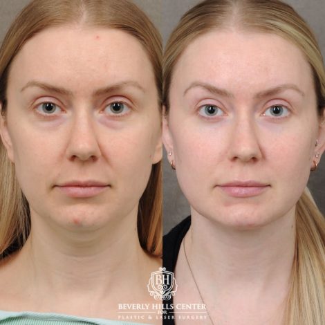 female patient before and after Weekend Necklift & Lower Blepharoplasty
