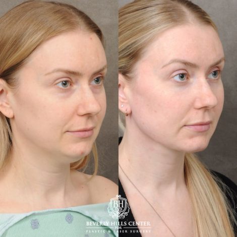 female patient before and after Weekend Necklift & Lower Blepharoplasty