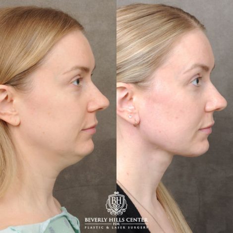 female patient before and after Weekend Necklift & Lower Blepharoplasty
