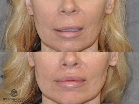 female patient before and after Modified Upper Lip Lift