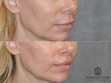 female patient before and after Modified Upper Lip Lift