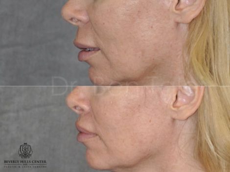female patient before and after Modified Upper Lip Lift