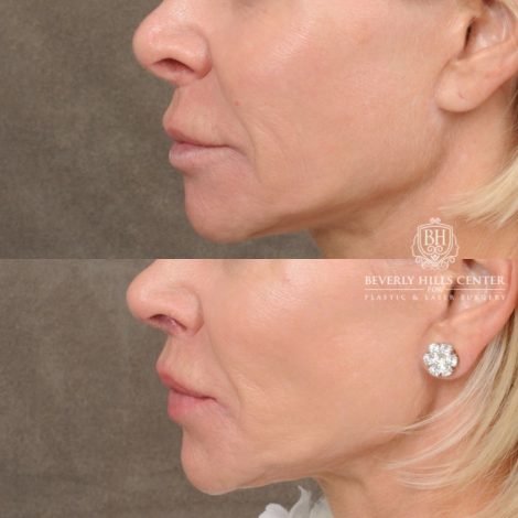 female patient before and after CUPID LIFT® Lip Lift