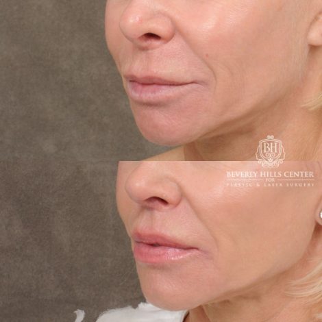 female patient before and after CUPID LIFT® Lip Lift