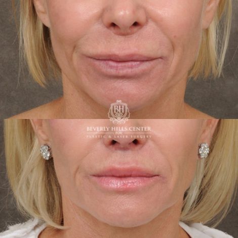 female patient before and after CUPID LIFT® Lip Lift